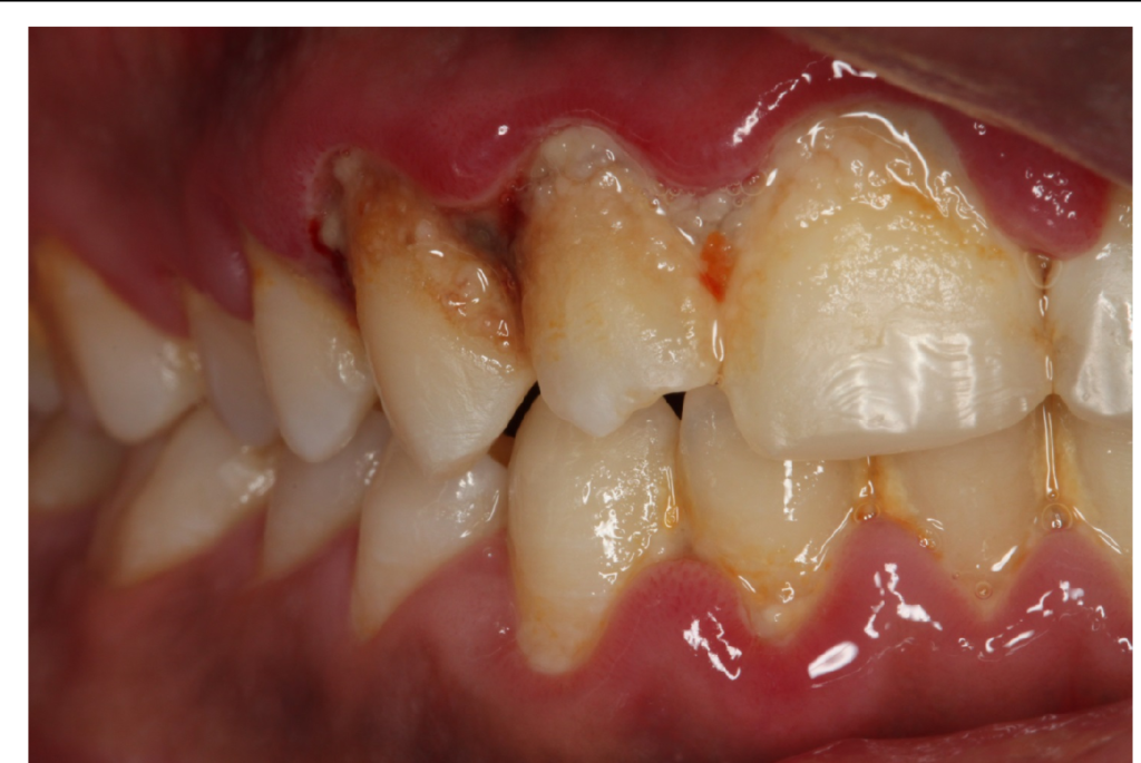 Ultimate Guide to Acute Necrotising Ulcerative Gingivitis (ANUG ...