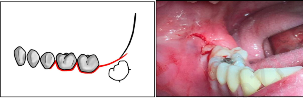 impaction