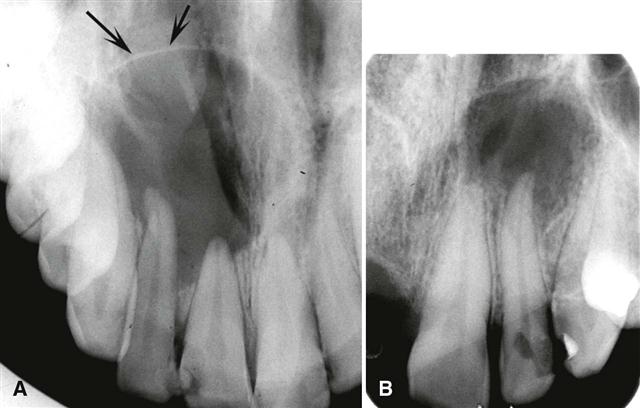 radicular cyst radiographic image