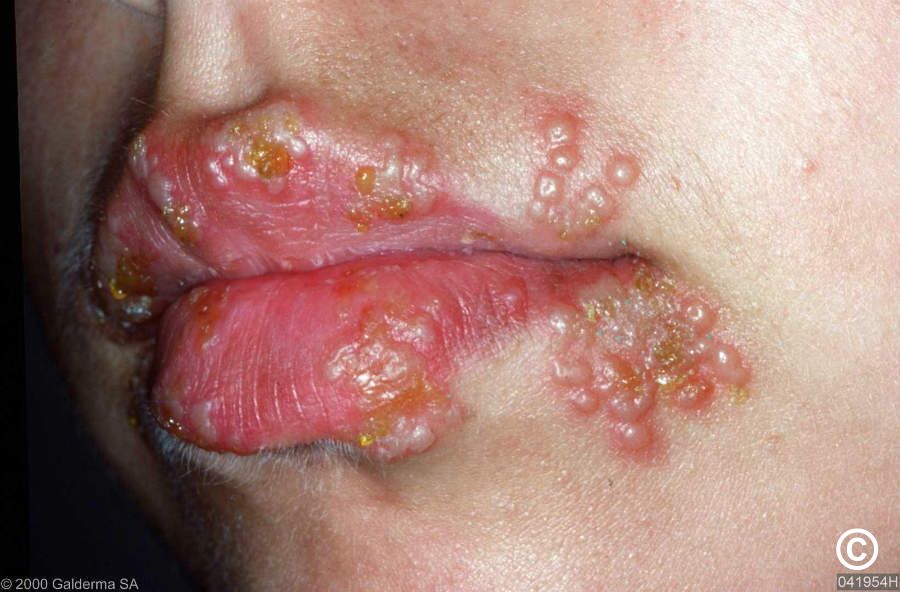 herpes symptoms