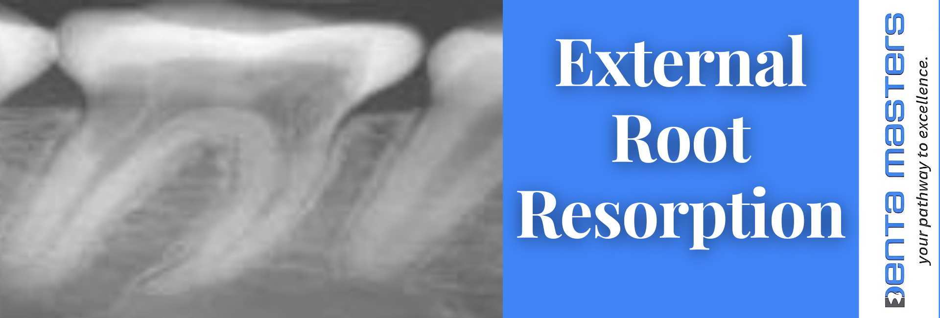 External Root Resorption: What You Need to Know