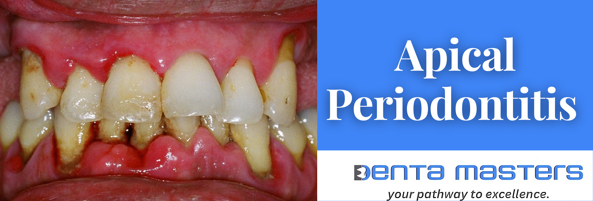 Apical Periodontitis: What You Need to Know