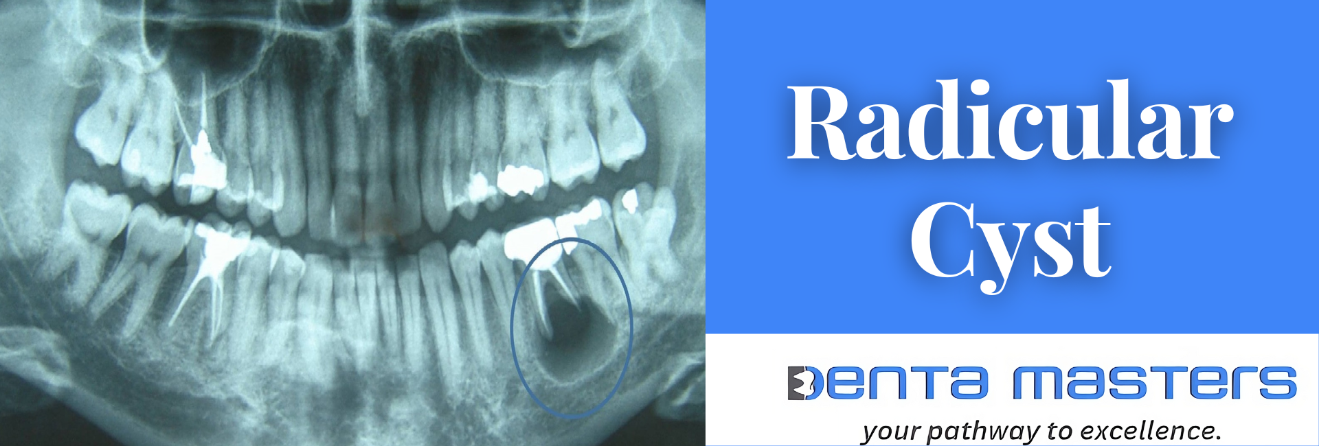 Radicular Cyst Diagnosis: What You Need to Know