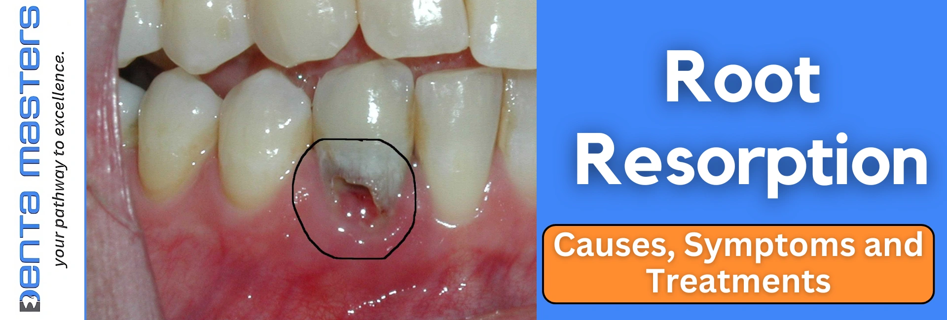 External Root Resorption: Cause, Symptoms and Treatment