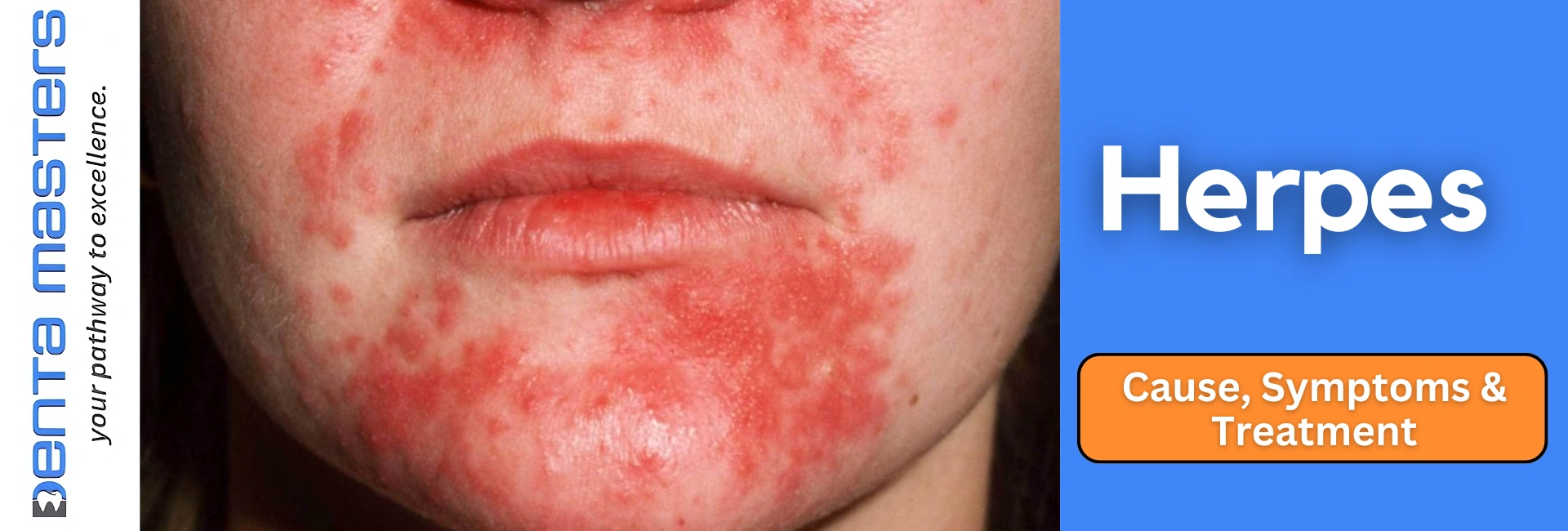 Herpes: Cause, Symptoms & Treatment
