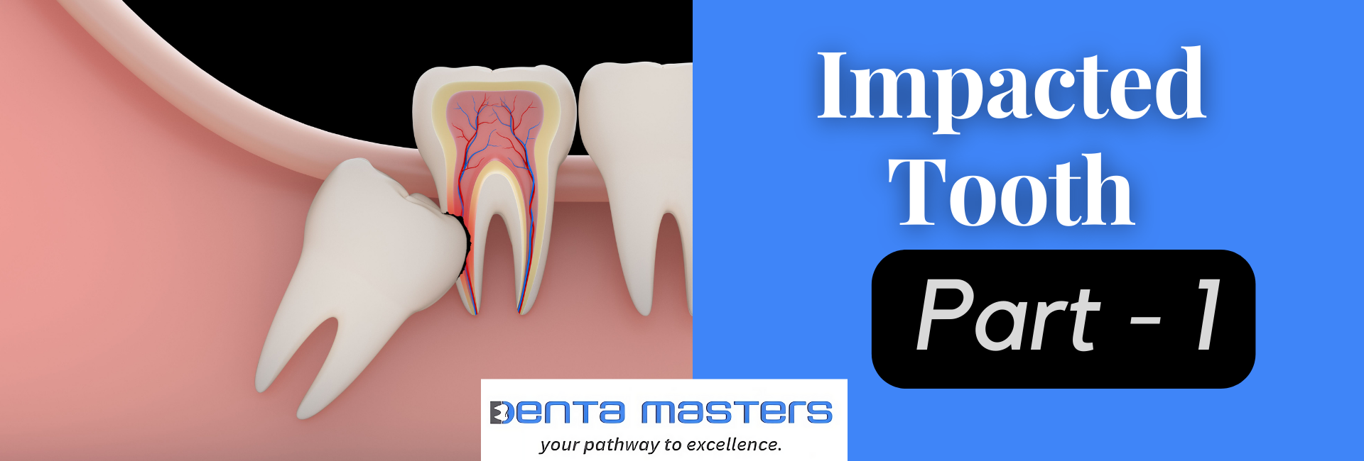 Impacted Wisdom Tooth: How to Prevent Complications (1/5)