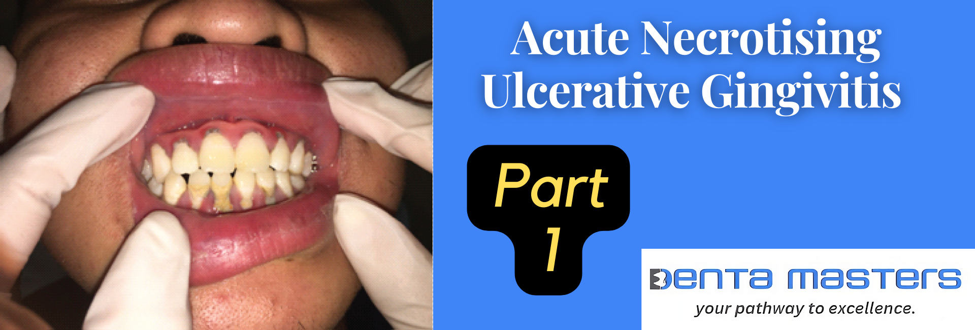 The Ultimate Guide to Acute Necrotising Ulcerative Gingivitis