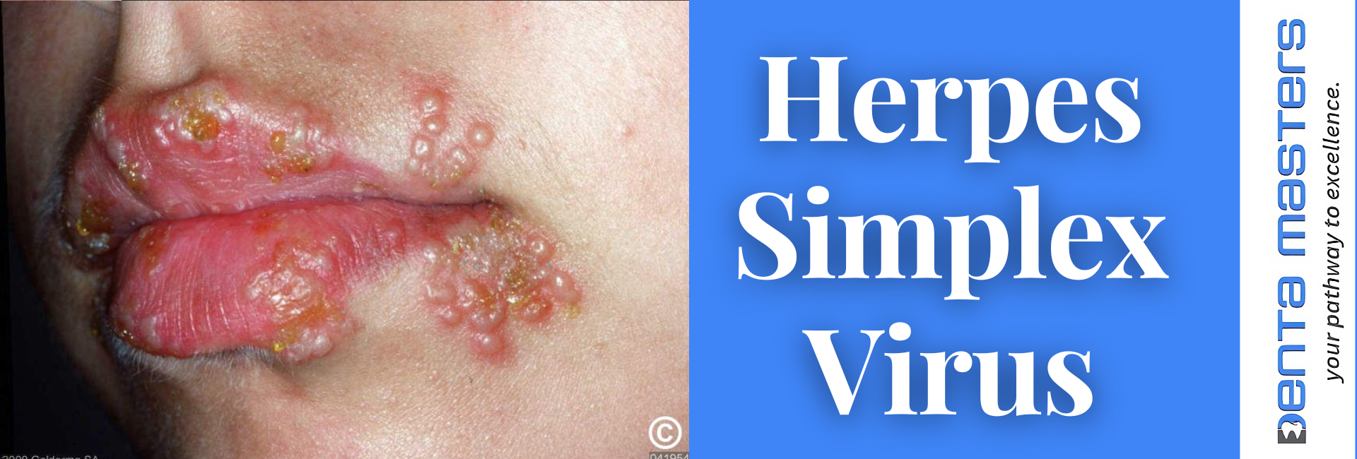 Herpes Simplex Virus: What You Need to Know?