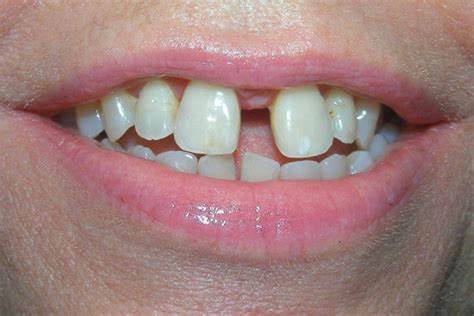 Diastema