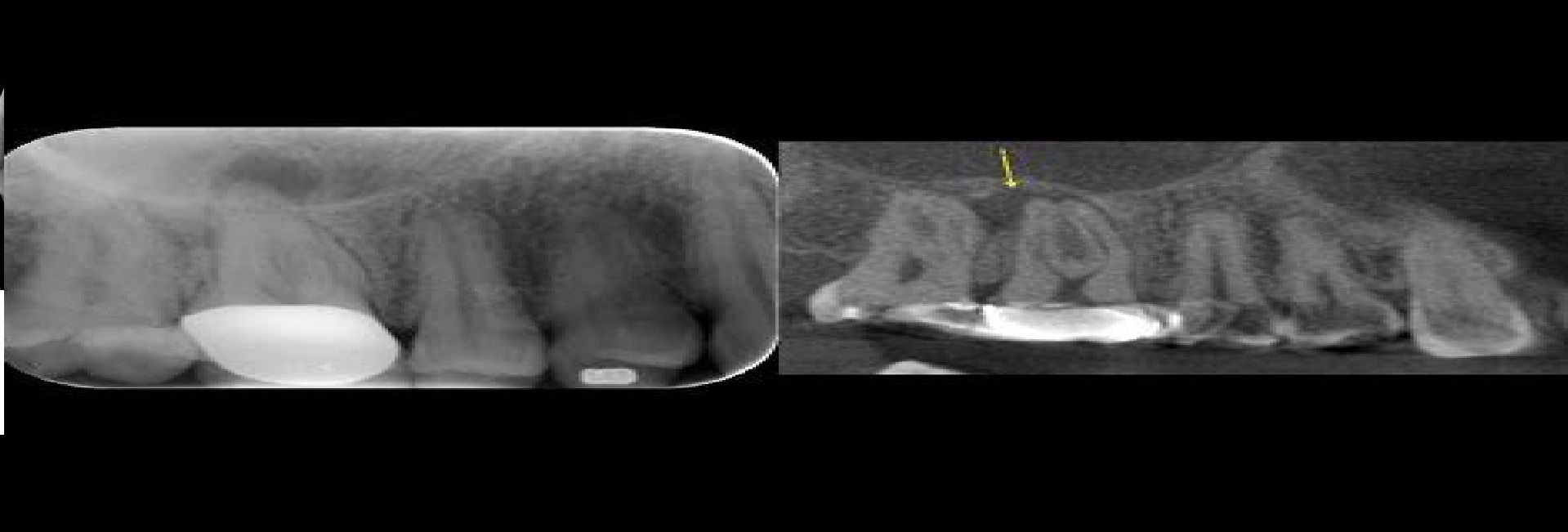 Asymptomatic Apical Periodontitis