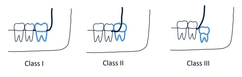 impaction