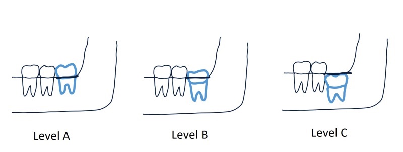 impaction