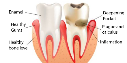 apical periodontitis