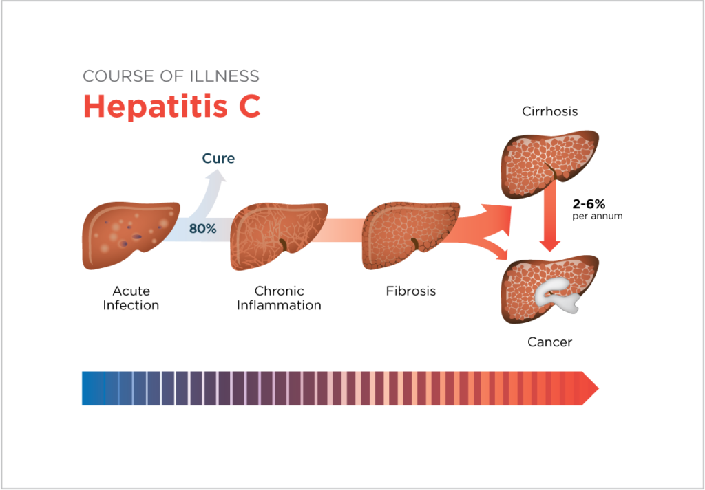 liver cirrhosis stages