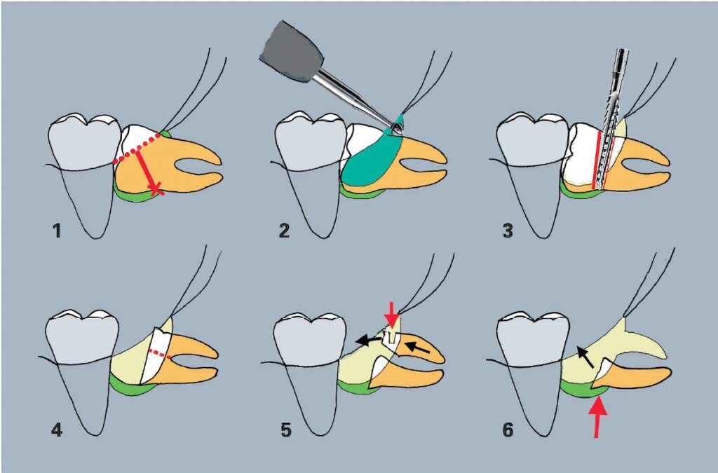 impaction