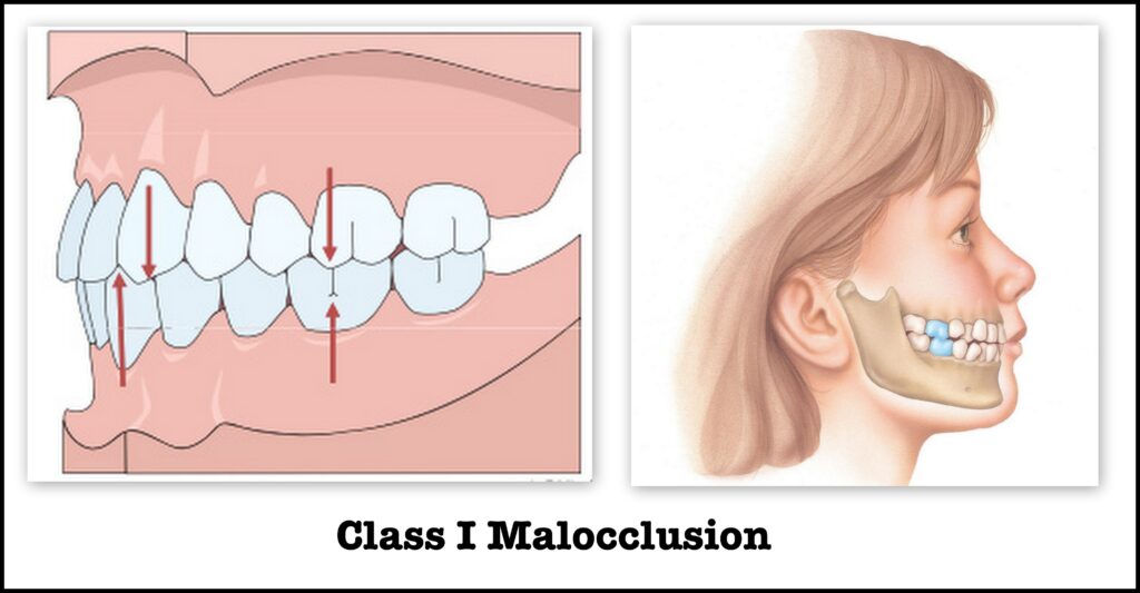 class I occlussion