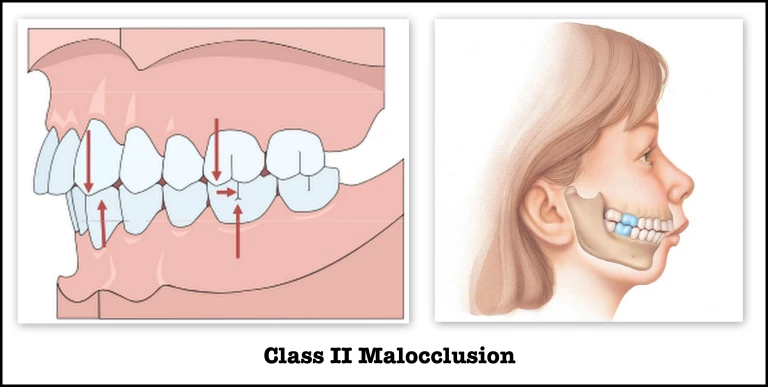 class-ii-maloccusion