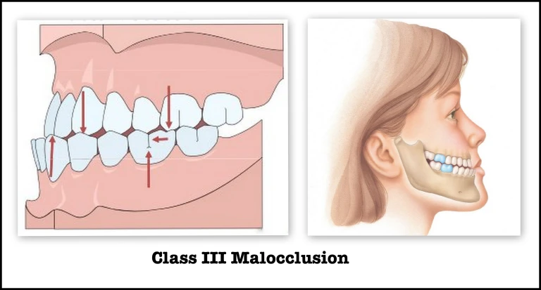 class-iii-malocclusion