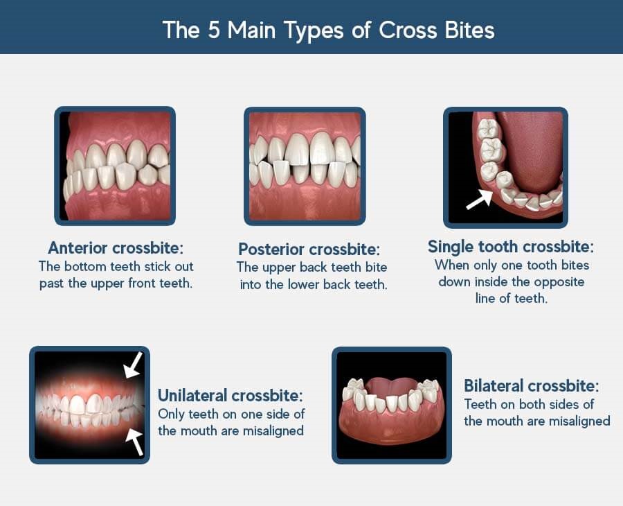 cross bite