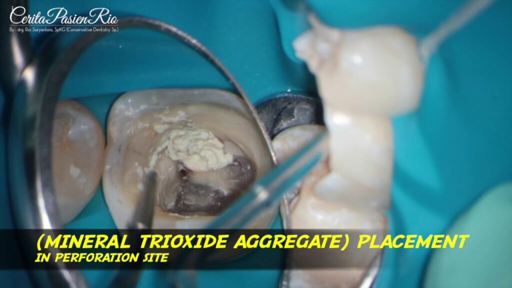 repairing lateral perforation