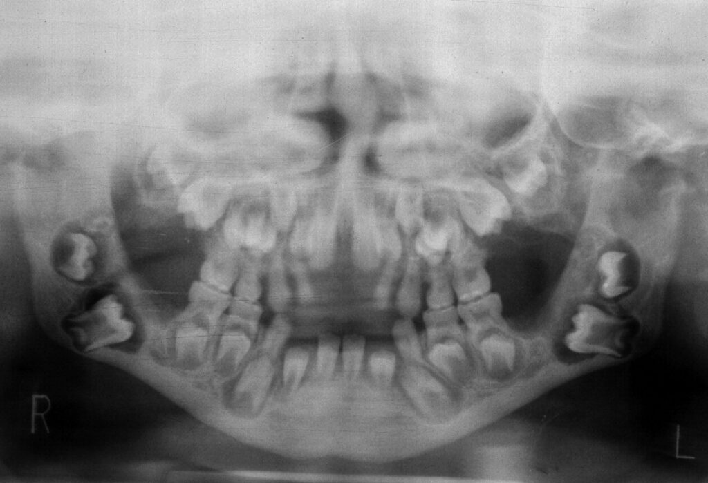 MUCOPOLYSACCHARIDOSIS TYPE 1 (HURLERS SYNDROME) OPG