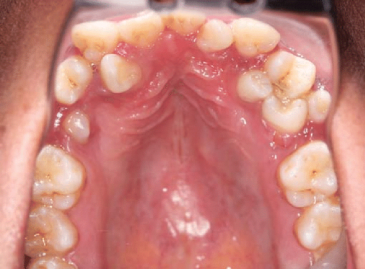 SUPERNUMERARY TEETH