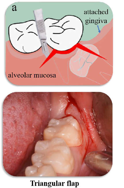 impaction