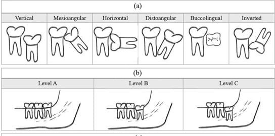 impaction