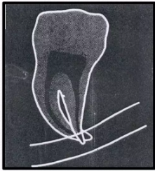 impaction