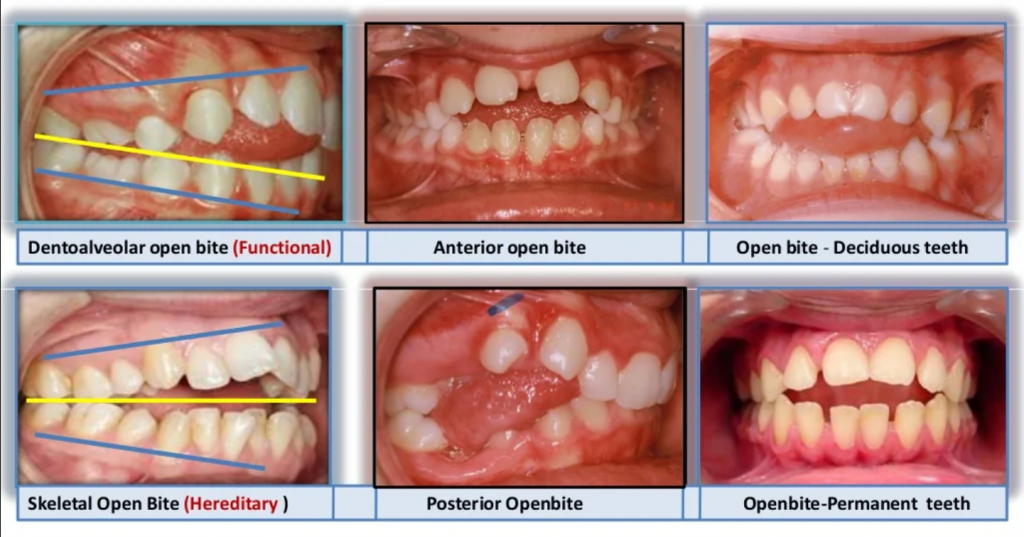 types of open bite