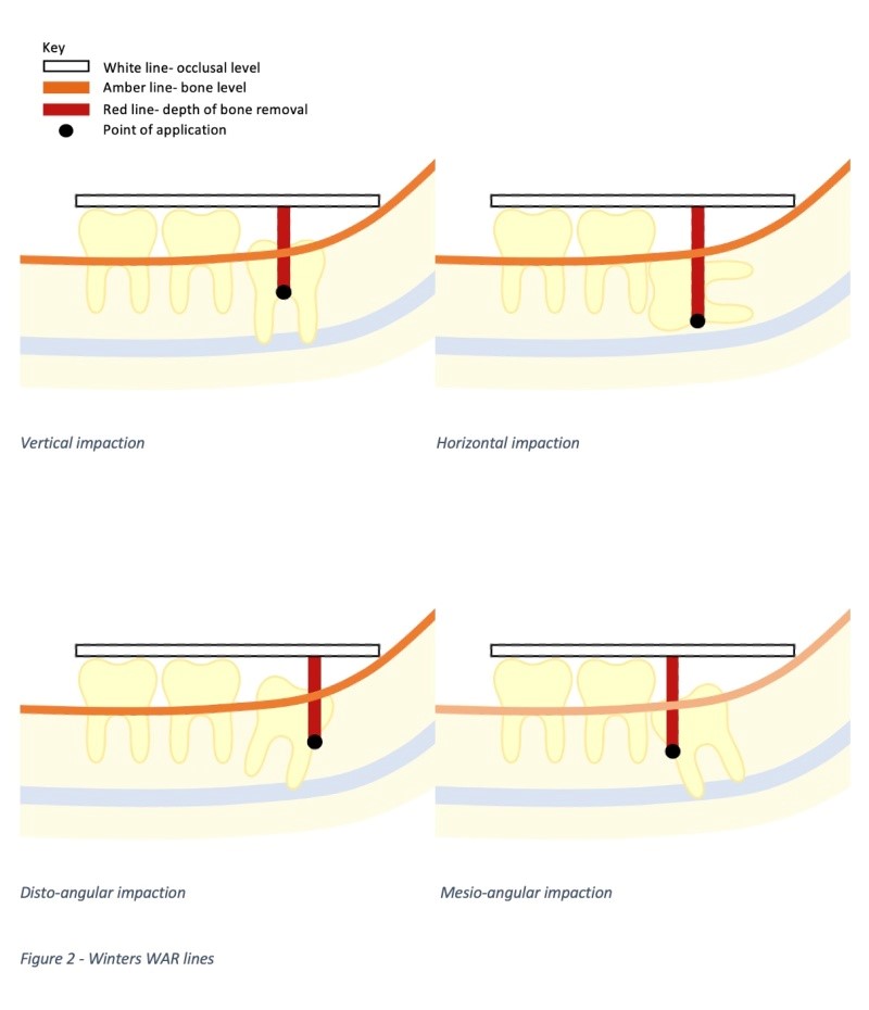 impaction