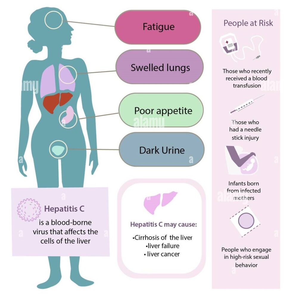 hepatitis-c-diagram-indicating-the-effects-of-hepatitis-c-description-of-the-illness-and-other-facts