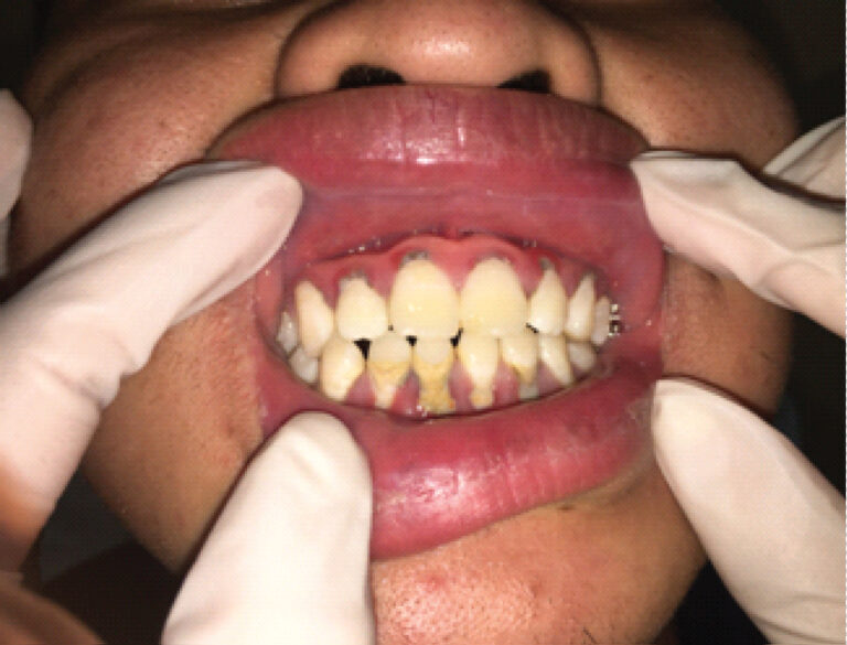 Acute necrotizing ulcerative gingivitis with tongue ulcer. Frontal view with closed mouth showed inflammation and necrosis of the upper gingiva.