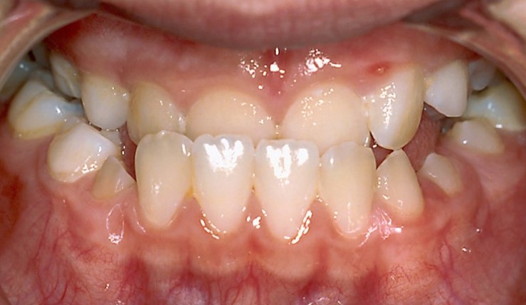 posterior cross bite