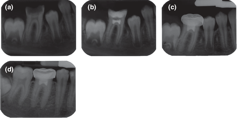 Radiographic evaluation of