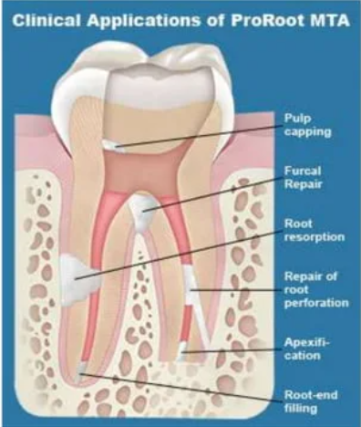 clinical application of MTA