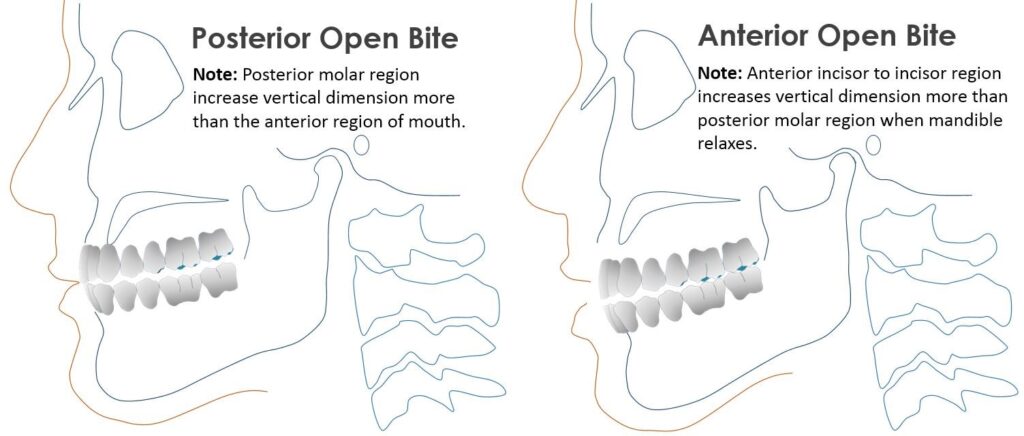 open bite