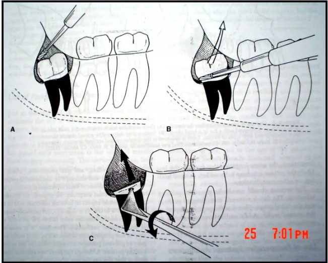 impaction