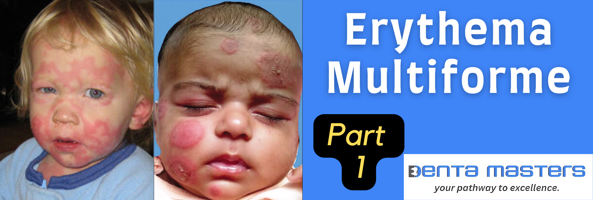 Erythema Multiforme: What You Need to Know, Part-1