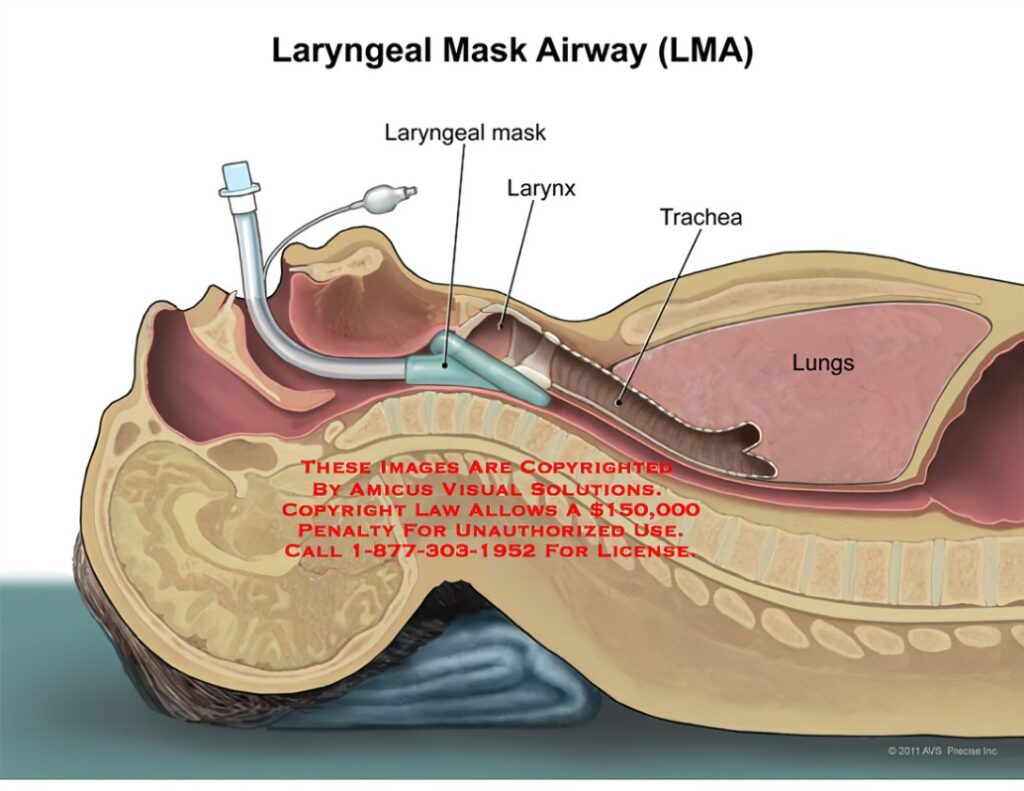 Laryngeal Mask Airway