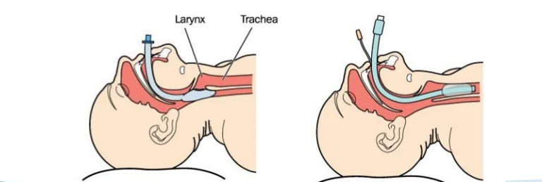 orotrachela intubation