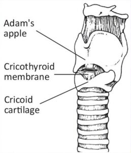 cricothyroidectomy