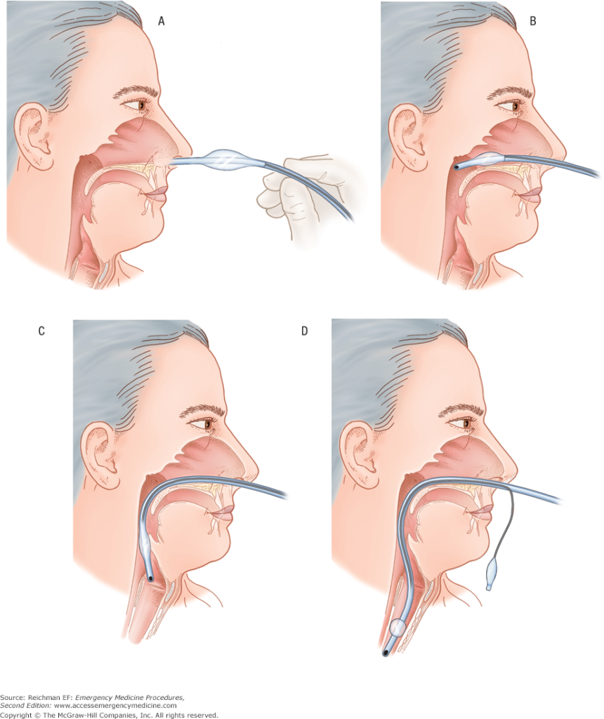 nasotracheal intubation