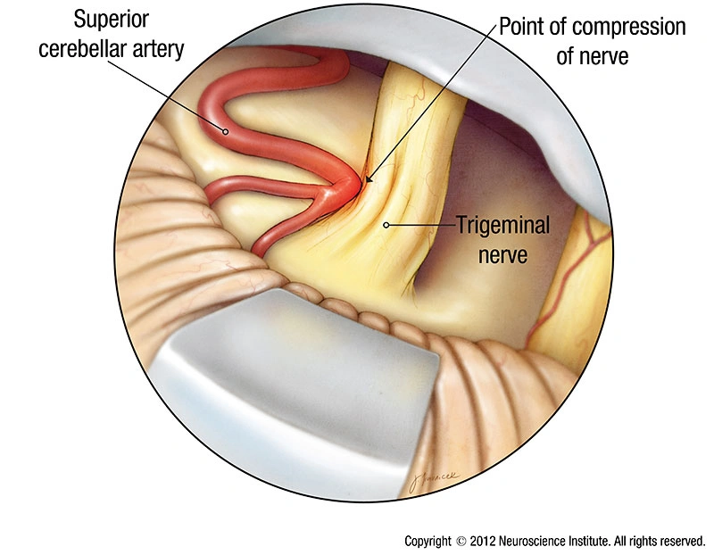 trigeminal nerve compression by artery