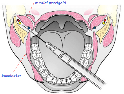 inferior alveolar nerve