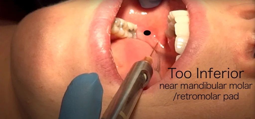 inferior alveolar nerve block soft tissue landmarks